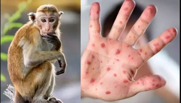 المغرب يسجل أوّل إصابة بجدري القردة في شمال أفريقيا