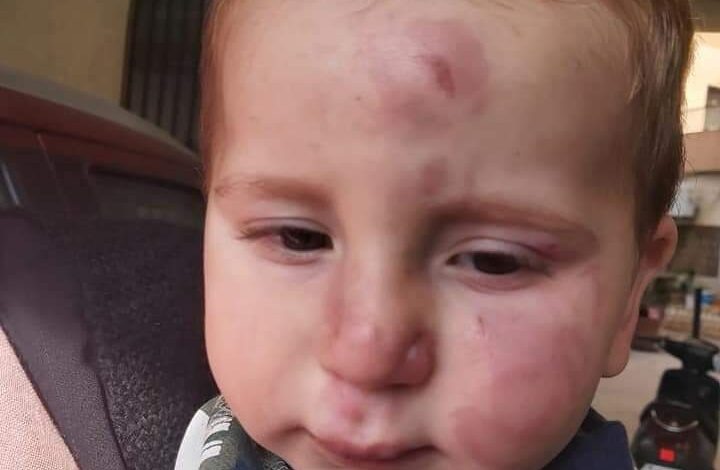 طفل يتعرض للضرب المبرح في احدى الحضانات اللبنانية.. ووالدته تروي ما حصل