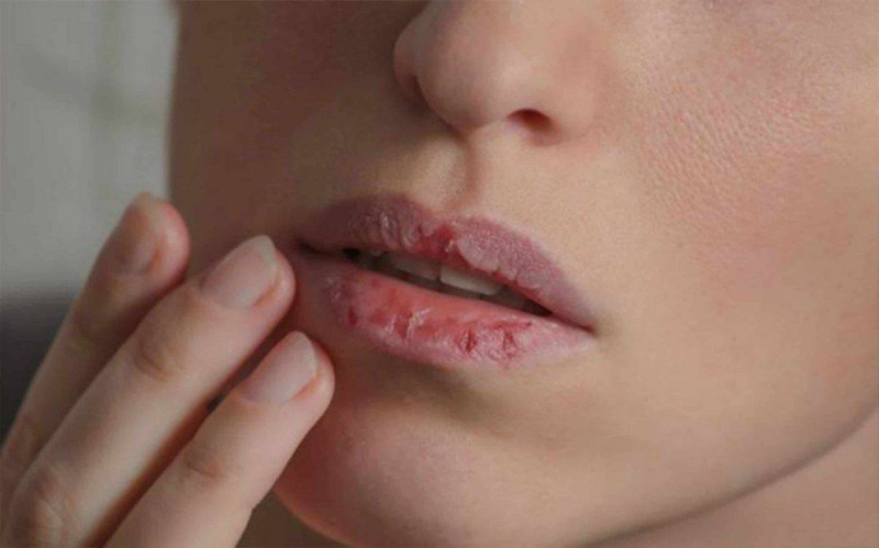 أربع أسباب صحية مقلقة وراء تشقق الشفاه