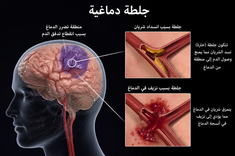 "نبض القلب" علامة حيوية تتنبأ بـ"الجلطات الدماغية" بعيداً عن ضغط الدم