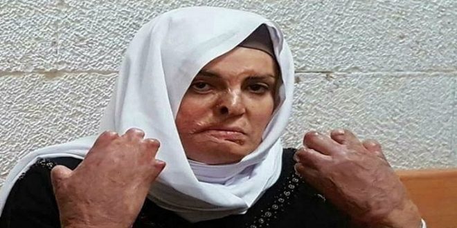 احرقها الاحتلال وبُترت أصابعها ... من هي الأسيرة المحررة إسراء جعابيص؟