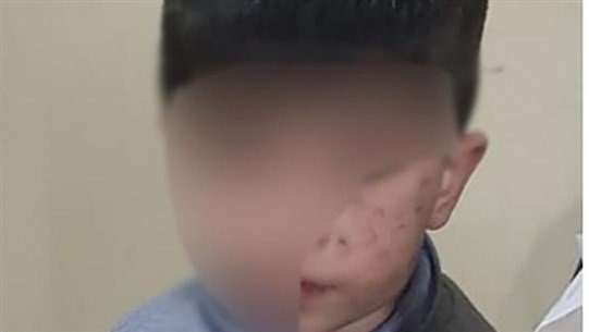ابن الـ4 سنوات عذّبه والده وجدته بأجسام صلبة