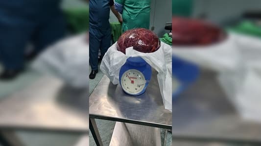 "مستشفى الزهراء".. إستئصال ورم ضخم من جسم شاب..