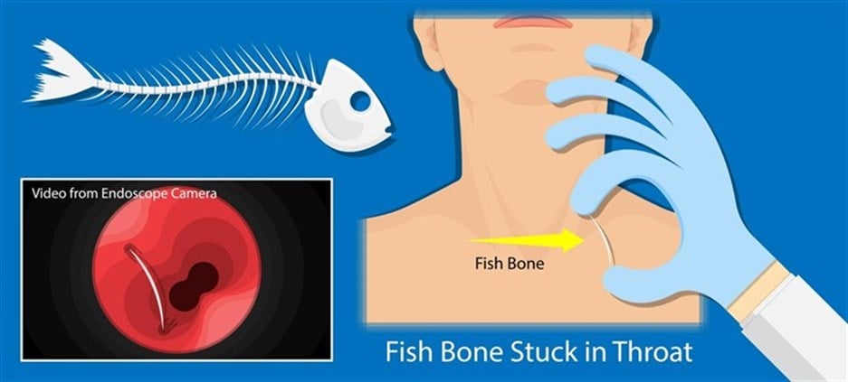 عندما تعلق شوكة سمك في الحلق... ماذا عليك أن تفعل؟