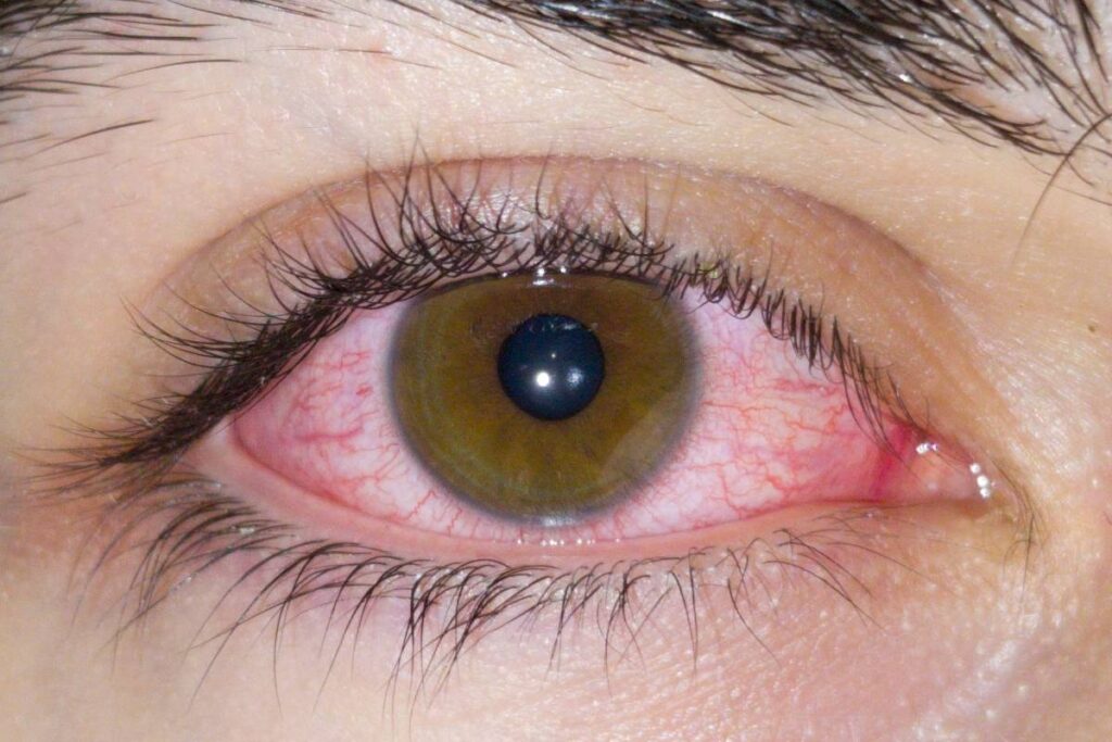 ما أسباب احمرار العينين في الصباح؟